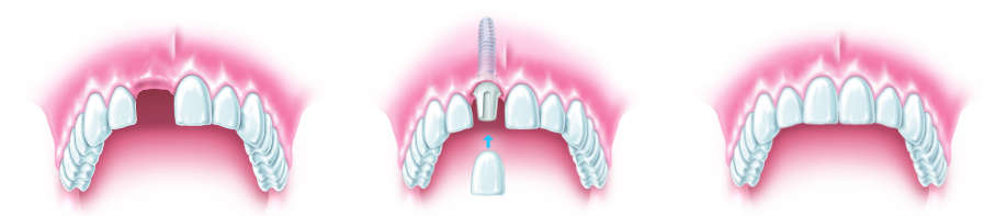 Einzelzahnimplantate