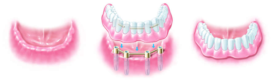 Prothesenstabilisierung